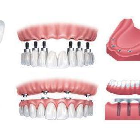 国家种植牙价格调整最新动态，最新消息汇总
