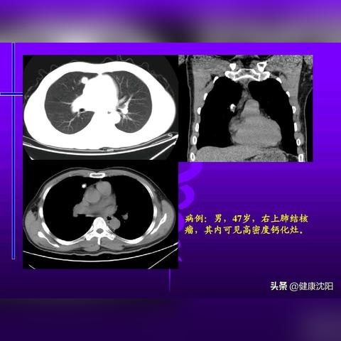 结节性硬化症最新研究进展概述
