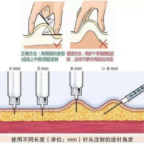 全自动胰岛素泵革新糖尿病管理